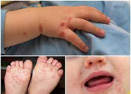 Phòng chống dịch bệnh chân tay miệng ở trẻ nhỏ